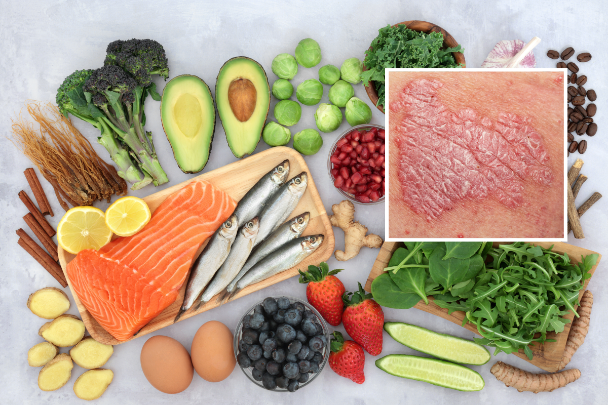 Alimentación saludable y psoriasis